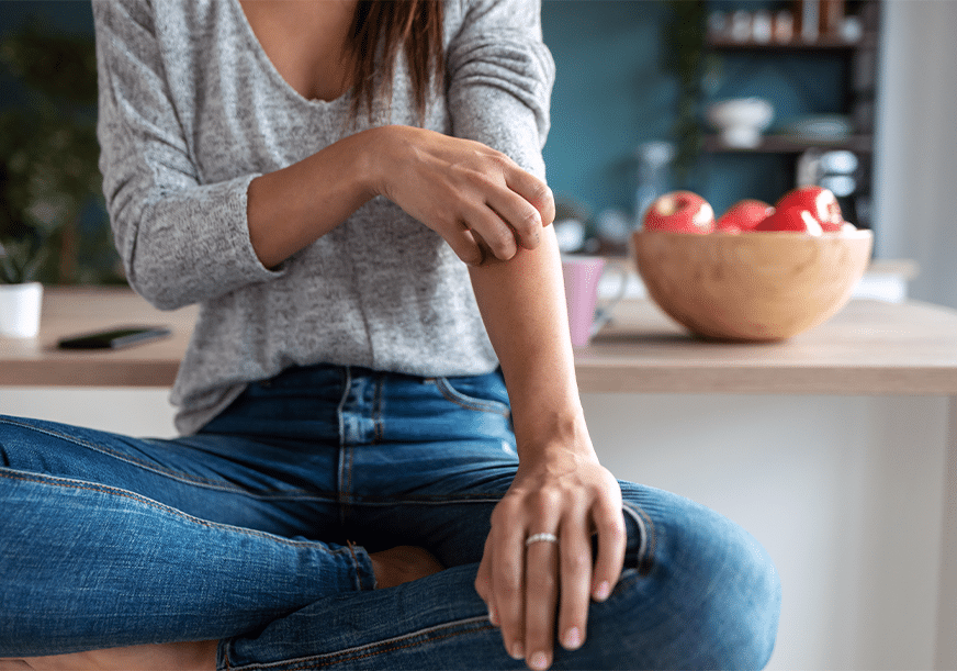 A woman scratches shingles on her arm