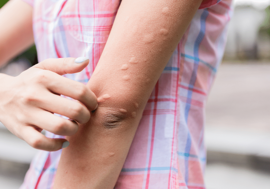 A woman scratches the hives on her arm