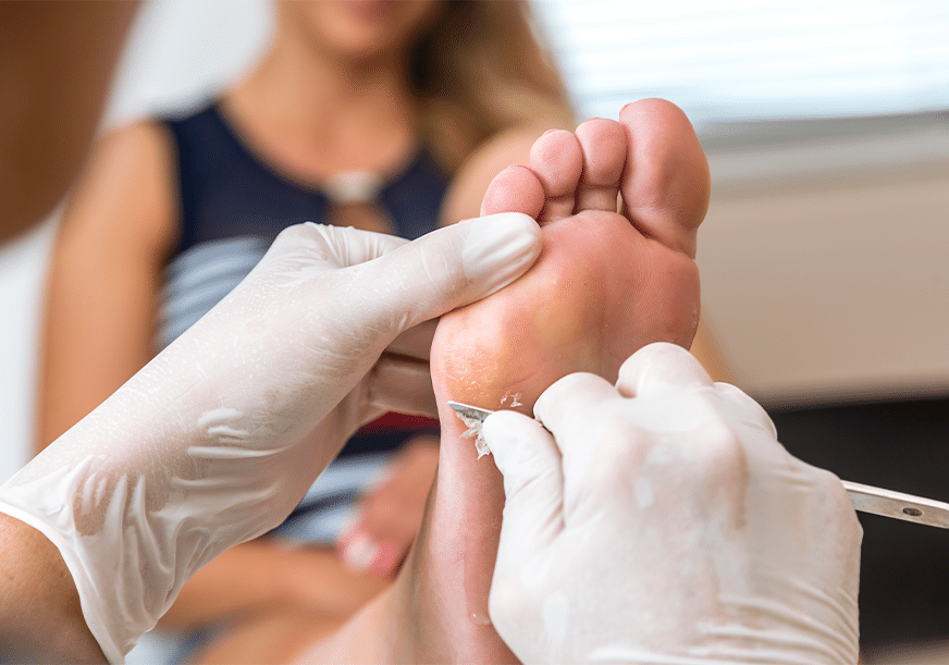 A doctor cuts a wart off a foot