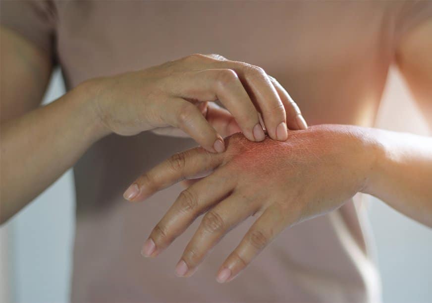 A person scratches their reddened hand