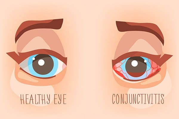 A diagram shows the difference between a healthy eye and a pink eye