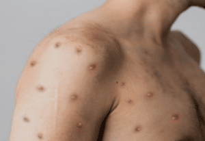 monkeypox symptoms